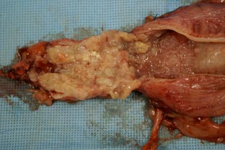 膀胱尿道の内腔